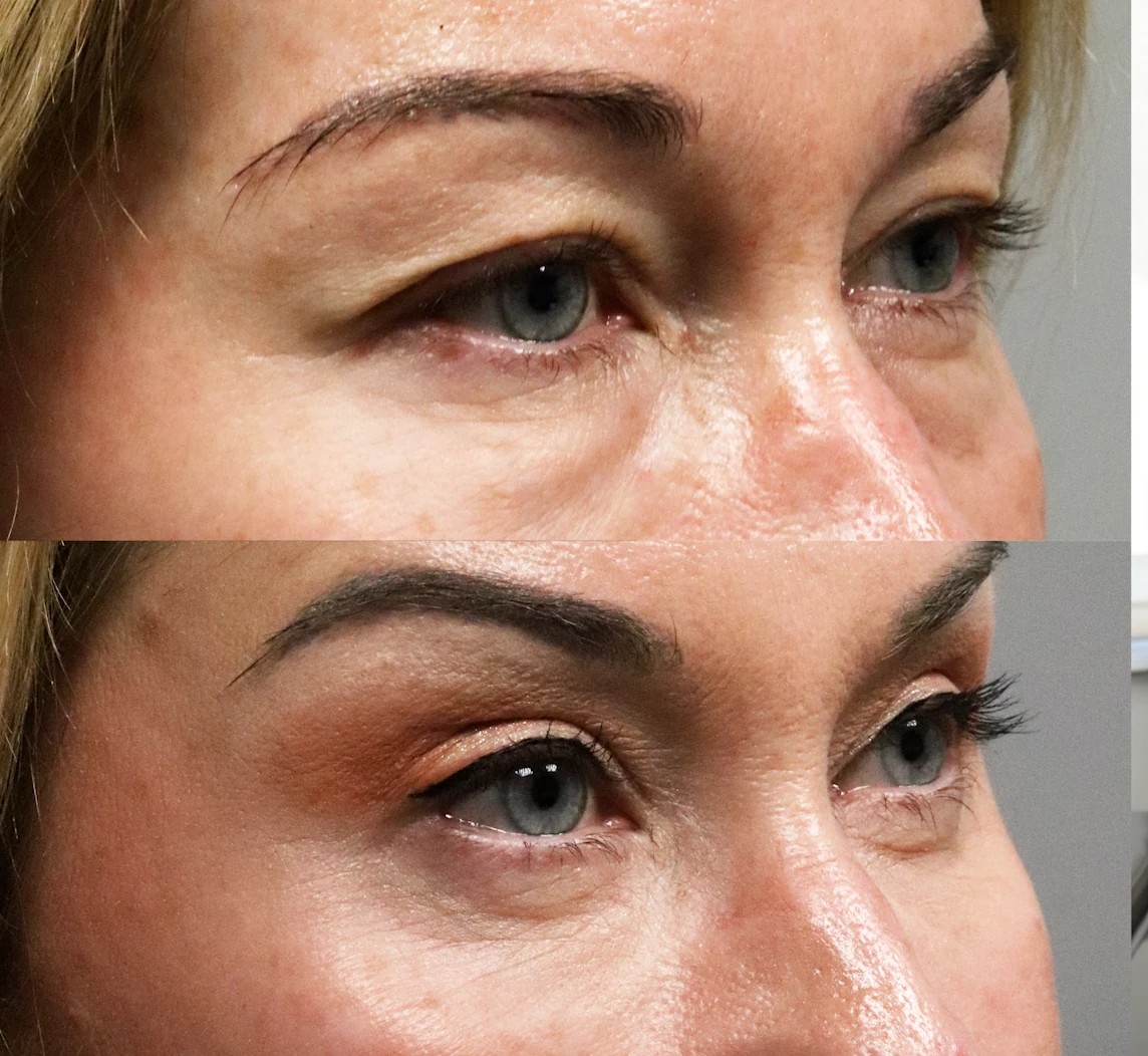 Upper eyelid treatment area