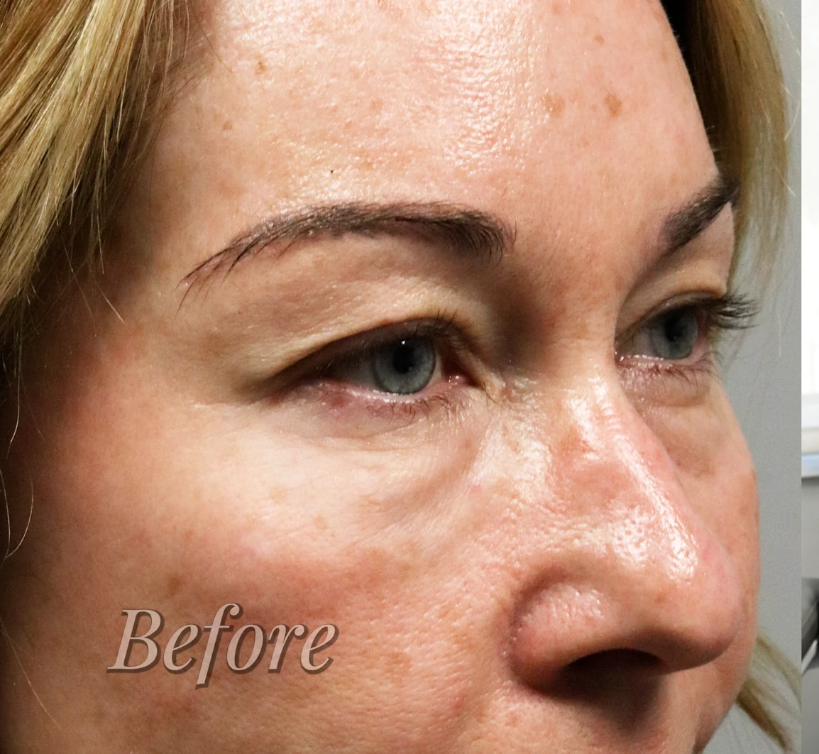 Lower-eyelid surgery planning placeholder