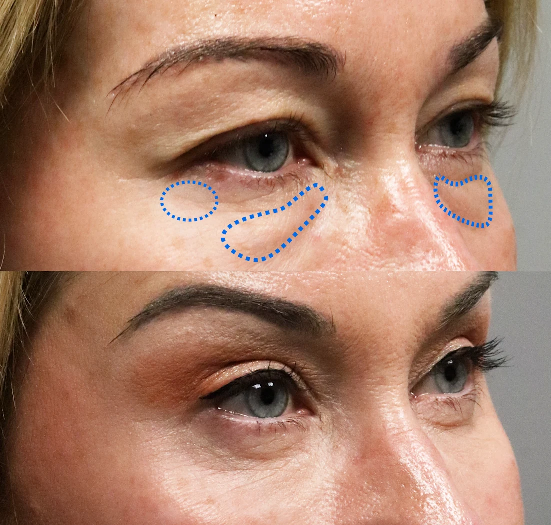 Close-up of the lower eyelid area