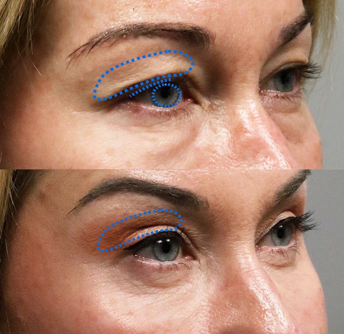Ptosis treatment area