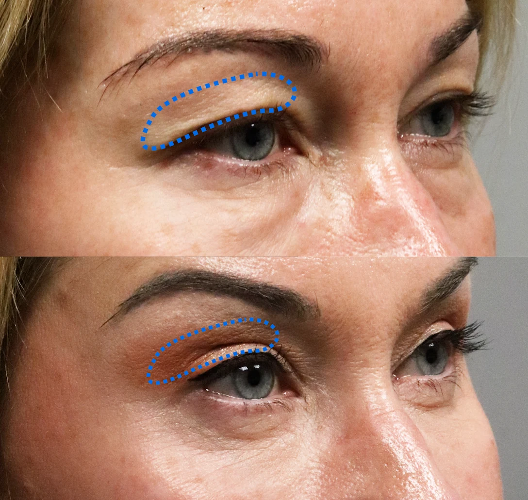 Bergen Eyelids patient story video