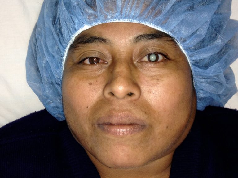 A photo of a woman patient before a cataract surgery in Guatemala.