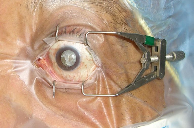 A photo of eye with cataract from a patient in Guatemala.