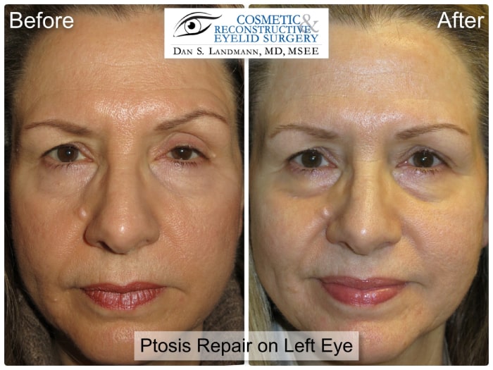 Before and after photos of Ptosis Repair on Left Eye at Cosmetic & Reconstructive Eyelid Surgery in River Edge, New Jersey. After photo shows a more open left eye.