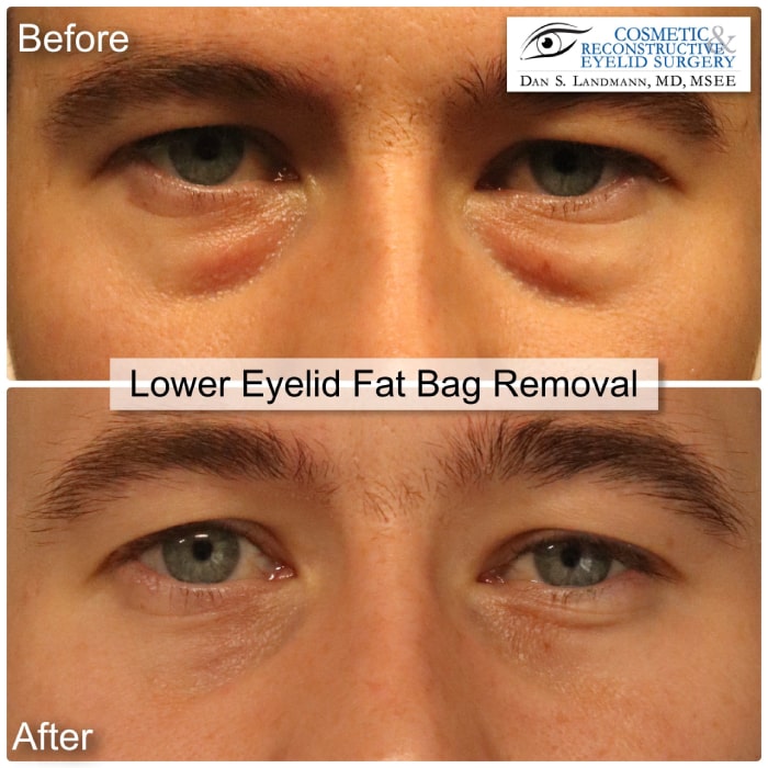 A before and after of a man who undergone Lower Eyelid Fat Bag Removal at Cosmetic & Reconstructive Eyelid Surgery in River Edge, New Jersey.