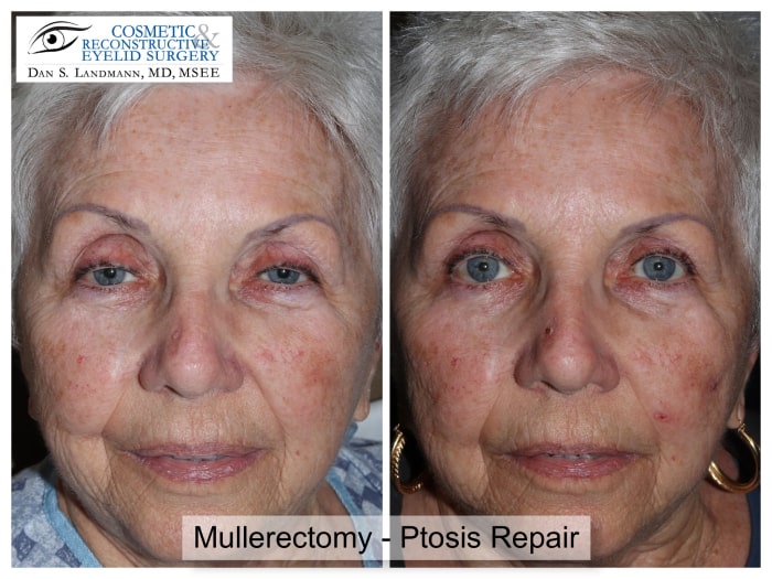 Before and after photos of Mullerectomy-Ptosis Repair at Cosmetic & Reconstructive Eyelid Surgery in River Edge, New Jersey. After photo shows a more open and defined eyes.