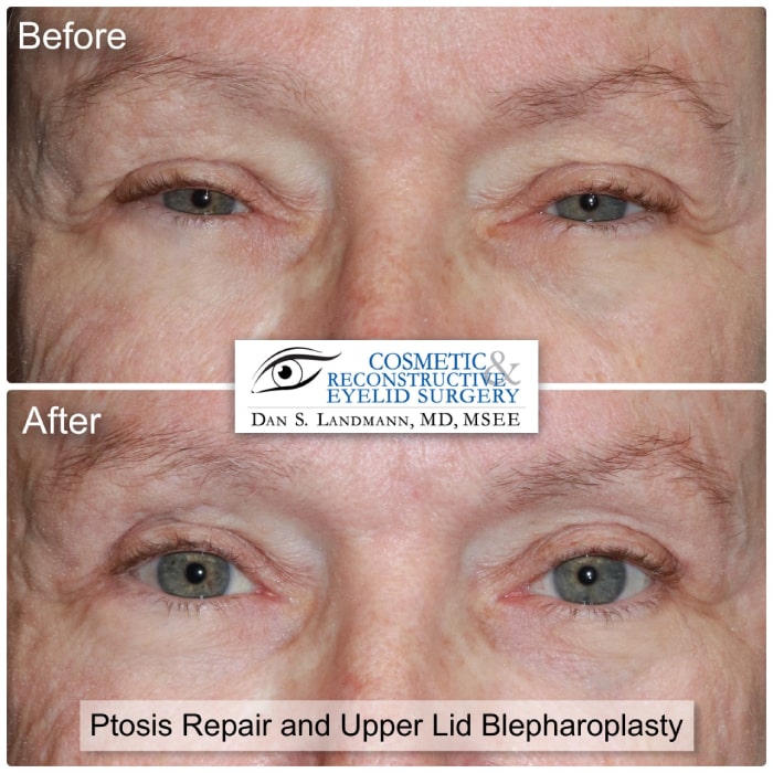 Before and after photos of Ptosis Repair and Upper Lid Blepharoplasty at Cosmetic & Reconstructive Eyelid Surgery in River Edge, New Jersey. After photos shows more open and defined eyes.