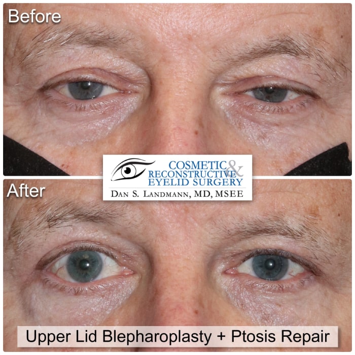 Before and after photos of Upper Lid Blepharoplasty and Ptosis Repair at Cosmetic & Reconstructive Eyelid Surgery in River Edge, New Jersey. After photo shows a more open and defined eyes.