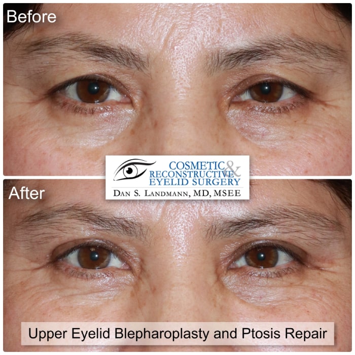 Before and after photos of Upper Eyelid Blepharoplasty and Ptosis repair at Cosmetic & Reconstructive Eyelid Surgery in River Edge, New Jersey. After photo shows a more open and defined eyes.