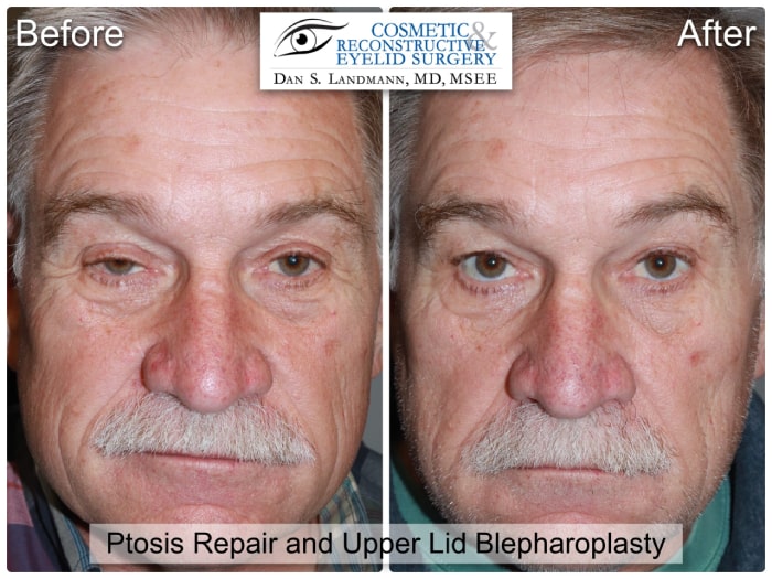 Before and after photos of Ptosis Repair and Upper Lid Blepharoplasty at Cosmetic & Reconstructive Eyelid Surgery in River Edge, New Jersey. The after photo shows a more open and defined eyes.