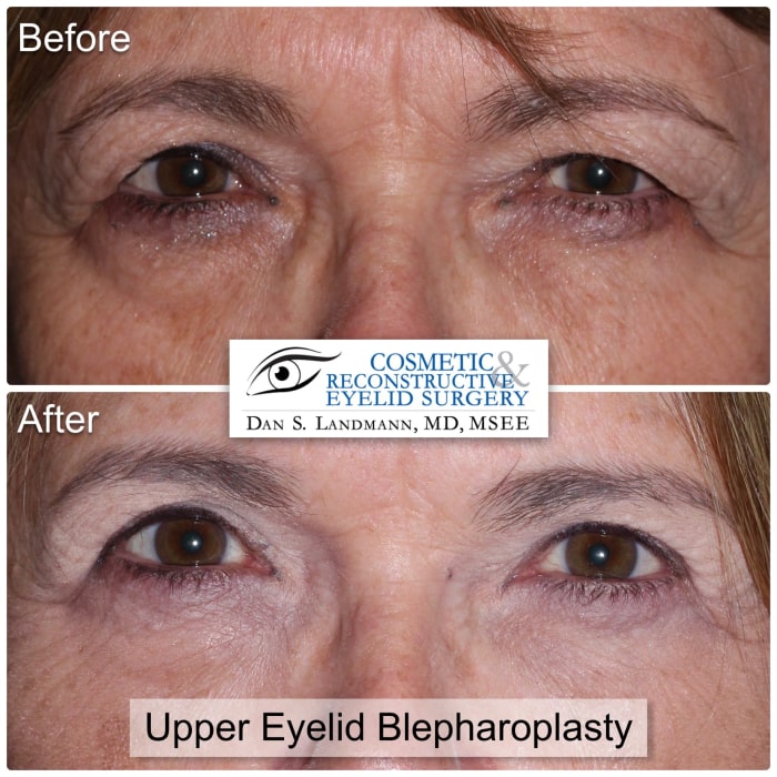 Before and after photos of Upper Eyelid Blepharoplasty at Cosmetic & Reconstructive Eyelid Surgery in River Edge, New Jersey. After photos shows a more open and defined eyes.
