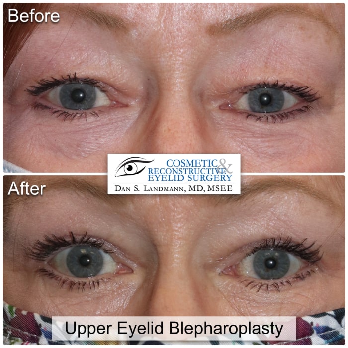 Before and after image of a woman who received upper eyelid blepharoplasty surgery in New Jersey.