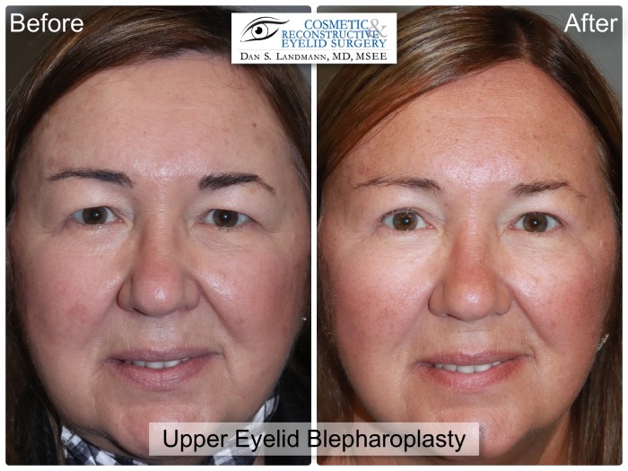 Close-up of a woman's face before and after Upper Eyelid Blepharoplasty surgery at Cosmetic & Reconstructive Eyelid Surgery in River Edge, New Jersey. The woman's upper eyelids are more youthful and refreshed in the after photo.