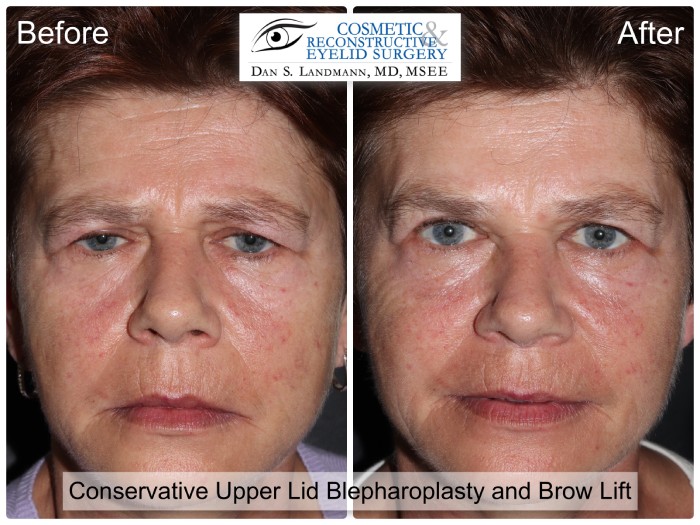 Before and after photos of a woman's face after Conservative Upper Lid Blepharoplasty and Brow Lift at Cosmetic & Reconstructive Eyelid Surgery in River Edge, New Jersey. The woman's eyelids are more open and defined in the after photo.