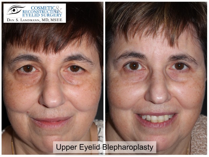 A before and after of a female patient from having saggy and hooded upper eyelids to a more awake appearance through Upper Eyelid Blepharoplasty at Cosmetic & Reconstructive Eyelid Surgery in River Edge, New Jersey.