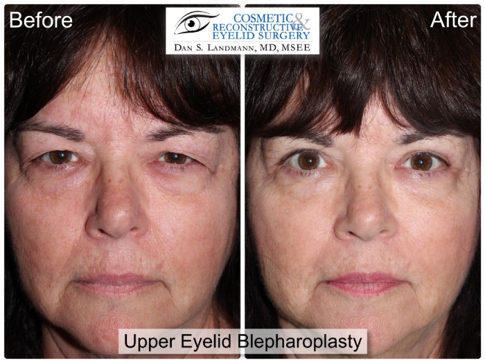 A before and after of a woman from having a drooping and hooded upper eyelids to a more awake and brighter appearance through Upper Eyelid Blepharoplasty at Cosmetic & Reconstructive Eyelid Surgery in River Edge, New Jersey.
