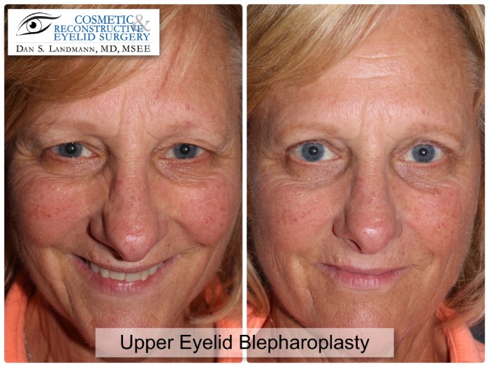 A before and after of a woman who undergone Upper Eyelid Blepharoplasty from having a hooded upper eyelids to a more brighter appearance at Cosmetic & Reconstructive Eyelid Surgery in River Edge, New Jersey.