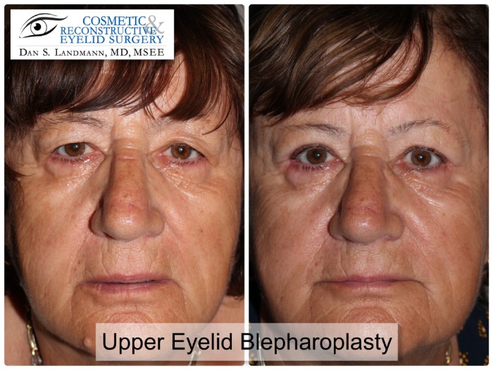 A before and after of a woman who undergone Upper Eyelid Blepharoplasty from a tired to a more awake appearance at Cosmetic & Reconstructive Eyelid Surgery in River Edge, New Jersey.