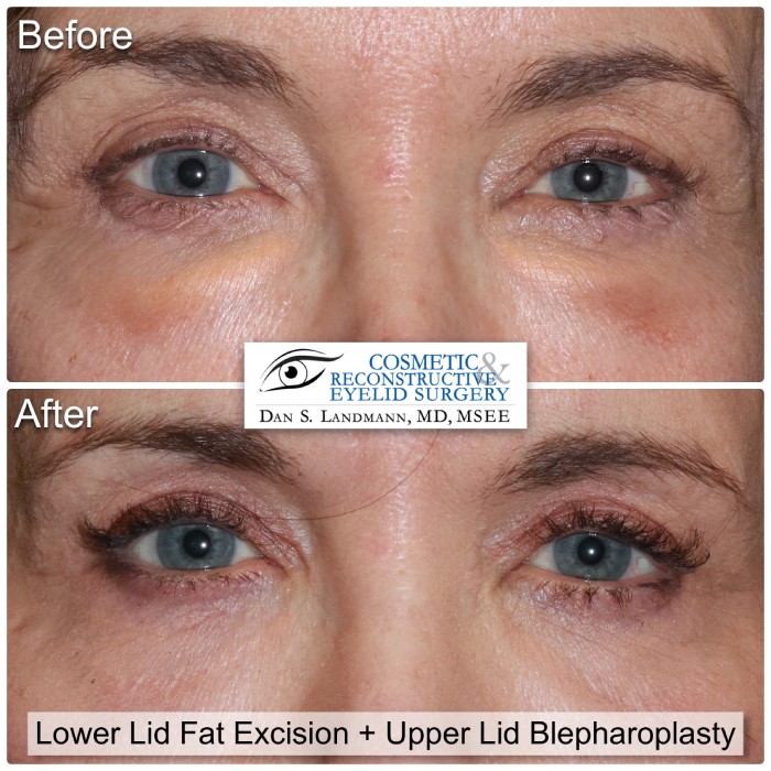A before and after of Lower Lid Fat Excision and Upper Lid Blepharoplasty at Cosmetic & Reconstructive Eyelid Surgery in River Edge, New Jersey.