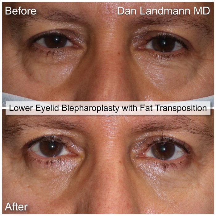 A before and after of Lower Eyelid Blepharoplasty with Fat Transposition at Cosmetic & Reconstructive Eyelid Surgery in River Edge, New Jersey.