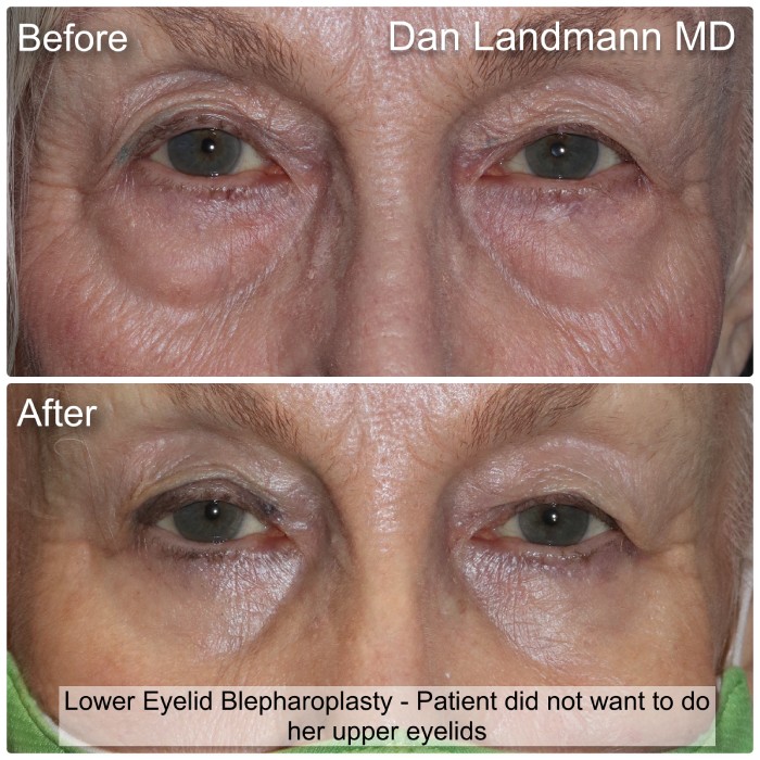 A before and after of Lower Eyelid Blepharoplasty at Cosmetic & Reconstructive Eyelid Surgery in River Edge, New Jersey.
