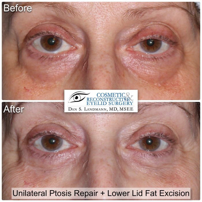 A before and after of Unilateral Ptosis Repair and Lower Lid Fat Excision at Cosmetic & Reconstructive Eyelid Surgery in River Edge, New Jersey.