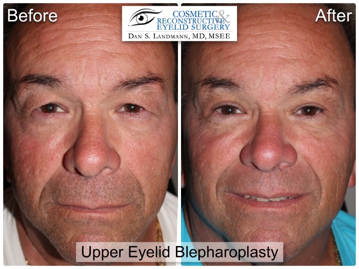 Before and after photos of a man's face after Upper Eyelid Blepharoplasty at Cosmetic & Reconstructive Eyelid Surgery in River Edge, New Jersey. The man's eyelids are more open and defined in the after photo.