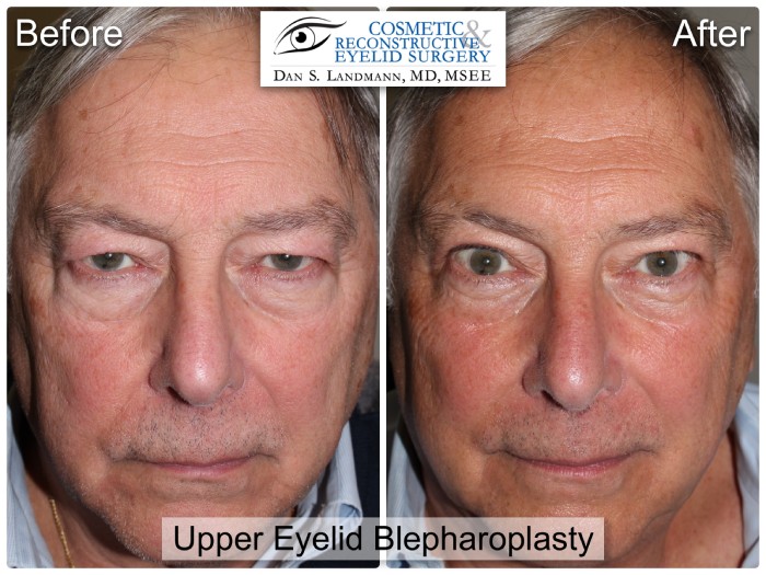 Before and after photos of a man's face after Upper Eyelid Blepharoplasty at Cosmetic & Reconstructive Eyelid Surgery in River Edge, New Jersey. The man's eyelids are more open and defined in the after photo.