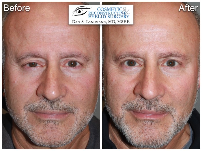 Before and after photos of a man's eyelids looking tired and sleepy to a brighter and more alive look from an Upper Eyelid Blepharoplasty at Cosmetic & Reconstructive Eyelid Surgery in River Edge, New Jersey.