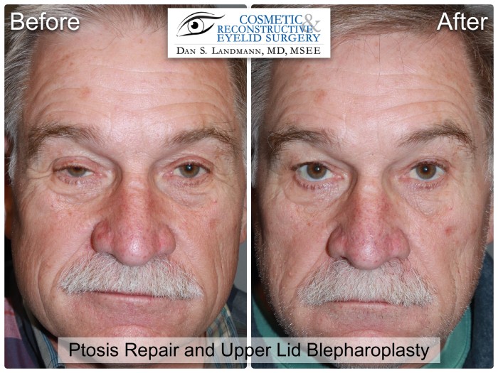 Before and after photos of a man's eyelids looking tired and sleepy to a brighter and more alive look from an Upper Eyelid Blepharoplasty at Cosmetic & Reconstructive Eyelid Surgery in River Edge, New Jersey.