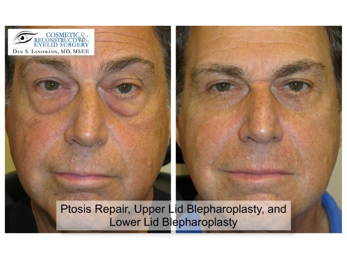 Before and after photos of a man's face after Ptosis Repair, Upper Lid Blepharoplasty, and Lower Lid Blepharoplasty at Cosmetic & Reconstructive Eyelid Surgery in River Edge, New Jersey. The man's eyelids are more open and defined in the after photo.