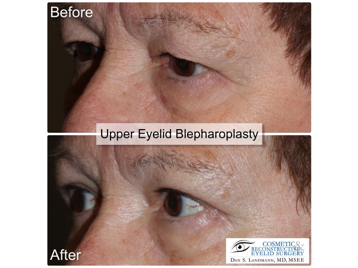 Before and after photos of a man's eyelid from droopy and saggy to a more open and defined eyelids from an Upper Eyelid Blepharoplasty at Cosmetic & Reconstructive Eyelid Surgery in River Edge, New Jersey.