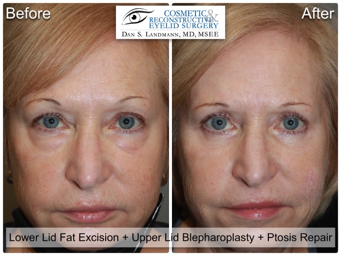 A before and after of a woman who undergone a Lower Lid fat Excision, Upper Lid Blepharoplasty and Ptosis Repair at Cosmetic & Reconstructive Eyelid Surgery in River Edge, New Jersey.