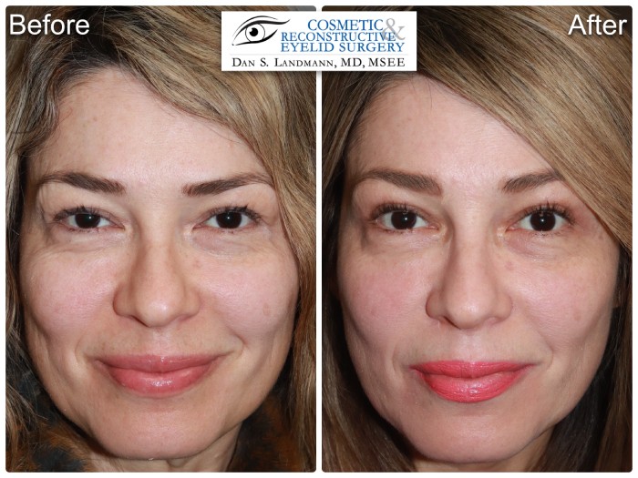 A before and after of a woman who undergone a Ptosis surgery from having drooping eyelids to a more awake appearance at Cosmetic & Reconstructive Eyelid Surgery in River Edge, New Jersey.