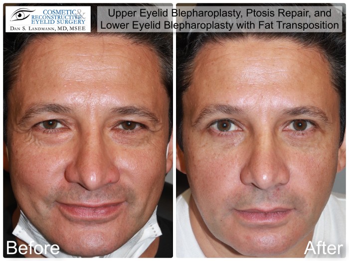 A before and after of a middle age male patient who undergone Upper Eyelid Blepharoplasty, Ptosis Repair, and Lower Eyelid Blepharoplasty with Fat Transposition at Cosmetic & Reconstructive Eyelid Surgery in River Edge, New Jersey.