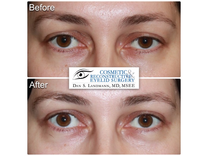 A before and after of a woman who undergone a Ptosis surgery at Cosmetic & Reconstructive Eyelid Surgery in River Edge, New Jersey.