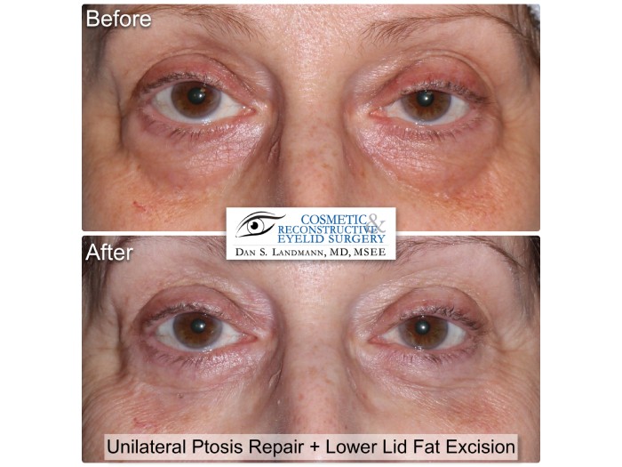 A before and after of a woman who undergone a Unilateral Ptosis Repair and Lower Lid Fat Excision at Cosmetic & Reconstructive Eyelid Surgery in River Edge, New Jersey.