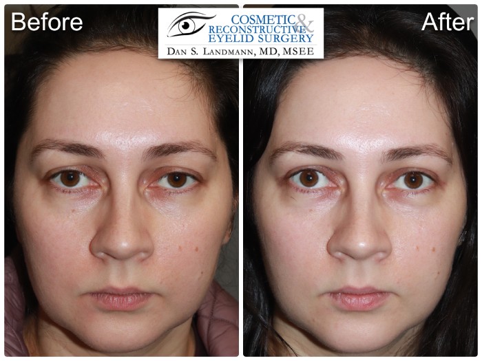 A before and after of a woman who undergone a Ptosis surgery at Cosmetic & Reconstructive Eyelid Surgery in River Edge, New Jersey.