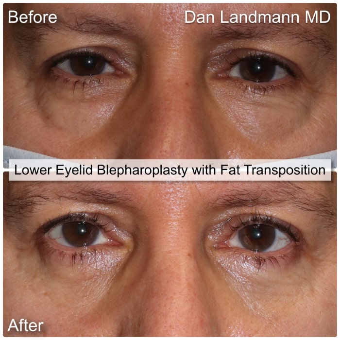 Before and After Image Lower Eyelid Blepharoplasty with Fat Transposition at Cosmetic & Reconstructive Eyelid Surgery in River Edge, New Jersey.