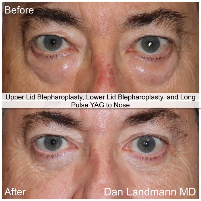 Before and After Image Upper Eyelid Blepharoplasty, Lower Lid Blepharoplast and Long Pulse YAG to Nose at Cosmetic & Reconstructive Eyelid Surgery in River Edge, New Jersey.