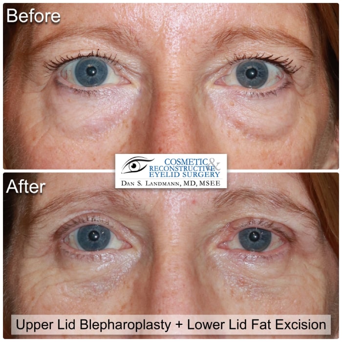 Before and After Image Upper Eyelid Blepharoplasty and Lower Lid Fat Excision at Cosmetic & Reconstructive Eyelid Surgery in River Edge, New Jersey.