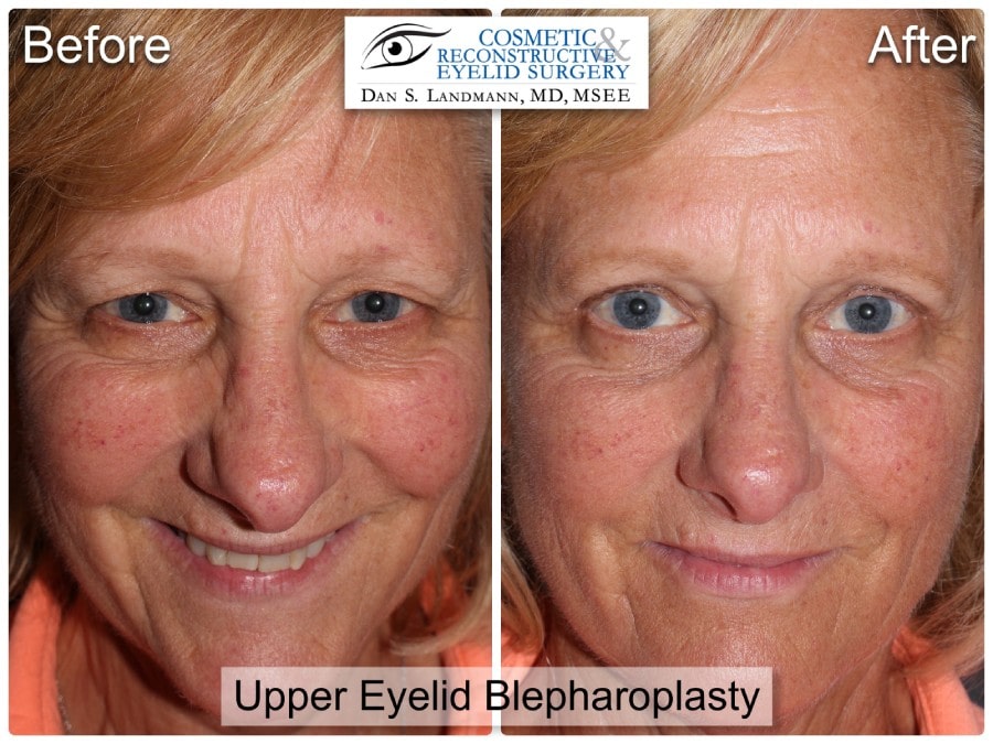 Before and After Image Upper Lid Blepharoplasty at Cosmetic & Reconstructive Eyelid Surgery in River Edge, New Jersey.