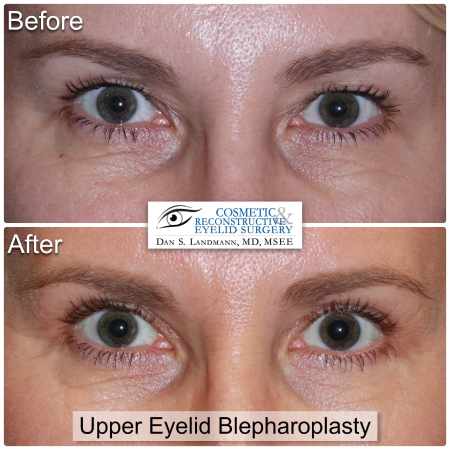 Before and After Image Upper Eyelid Blepharoplasty at Cosmetic & Reconstructive Eyelid Surgery in River Edge, New Jersey.