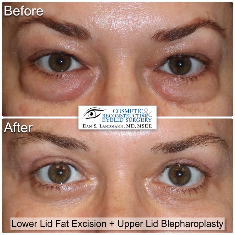 Before and After Image Upper Lid Blepharoplasty and Upper Lid at Cosmetic & Reconstructive Eyelid Surgery in River Edge, New Jersey.Blepharoplasty