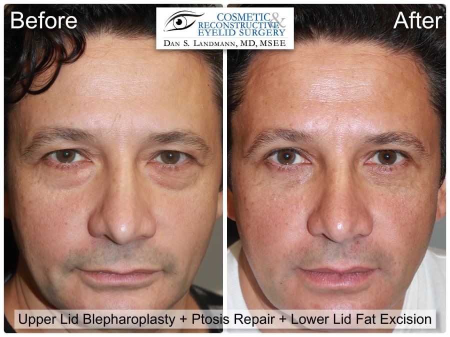 Before and After Image Upper Eyelid Blepharoplasty, Ptosis Repair and Lower Lid Fat Excision at Cosmetic & Reconstructive Eyelid Surgery in River Edge, New Jersey.