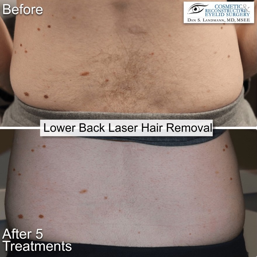 Before and After Photo of Lower Back Laser Hair Removal at Cosmetic & Reconstructive Eyelid Surgery in River Edge, New Jersey.