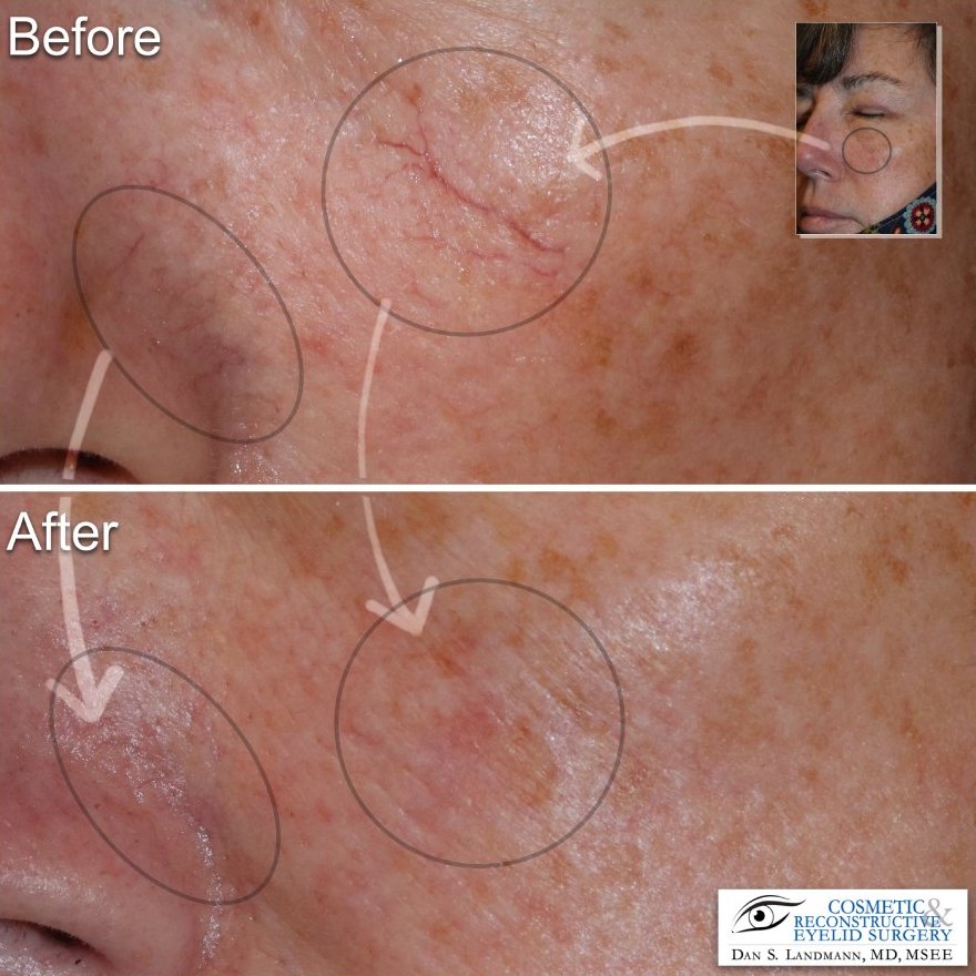 Before and after photos of a woman's face eliminating “Spider-veins” around the nose and mouth through Long Pulse treatment done by Nichole Van Nes.