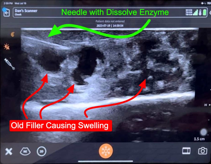 A scanned image showing the needle dissolving filler.
