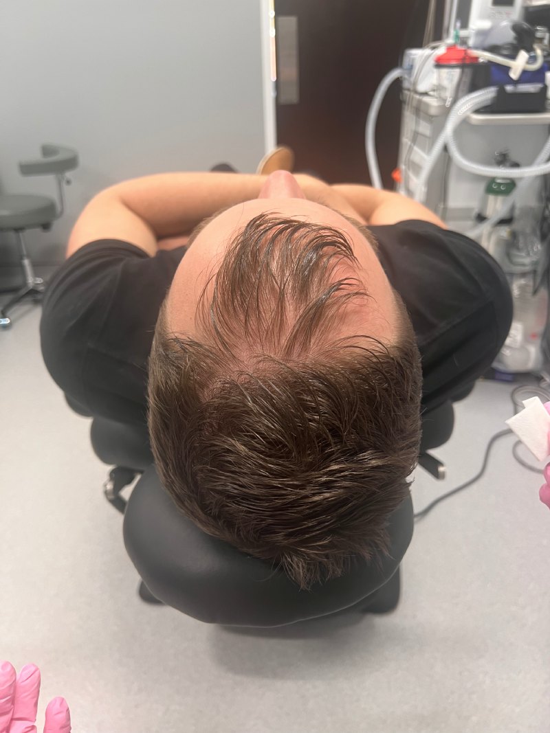 A photo of a male patient who had a hair restored through Plasma for Hair Restoration treatment.
