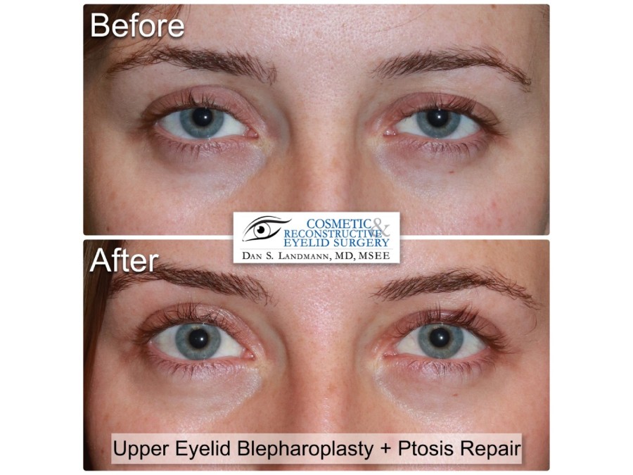 Before and after photos of Upper Eyelid Blepharoplasty and Ptosis Repair at Cosmetic & Reconstructive Eyelid Surgery in River Edge, NJ.